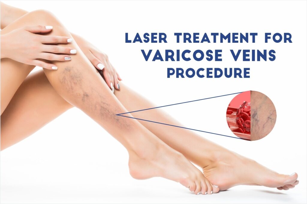 Laser Treatment for Varicose Veins Procedure